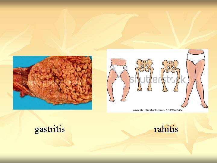 gastritis rahitis 