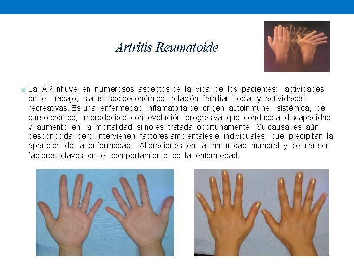 Artritis Reumatoide o La AR influye en numerosos aspectos de la vida de los
