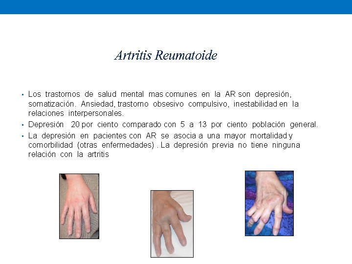 Artritis Reumatoide • Los trastornos de salud mental mas comunes en la AR son