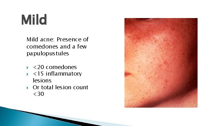 Mild acne: Presence of comedones and a few papulopustules <20 comedones <15 inflammatory lesions