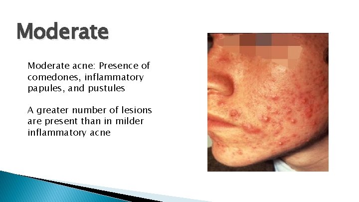 Moderate acne: Presence of comedones, inflammatory papules, and pustules A greater number of lesions