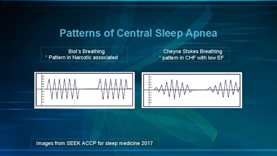 Patterns of Central Sleep Apnea Biot’s Breathing * Pattern in Narcotic associated Images from