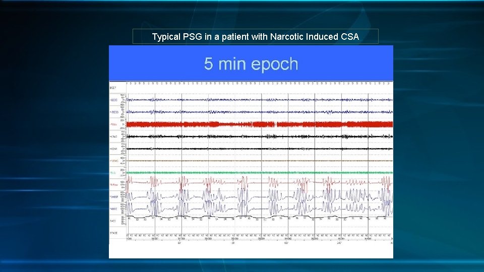 Typical PSG in a patient with Narcotic Induced CSA 