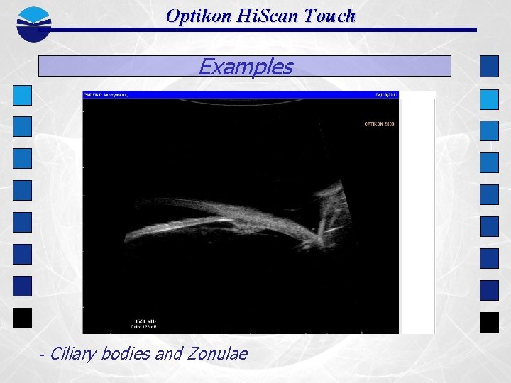 Optikon Hi. Scan Touch Examples - Ciliary bodies and Zonulae 