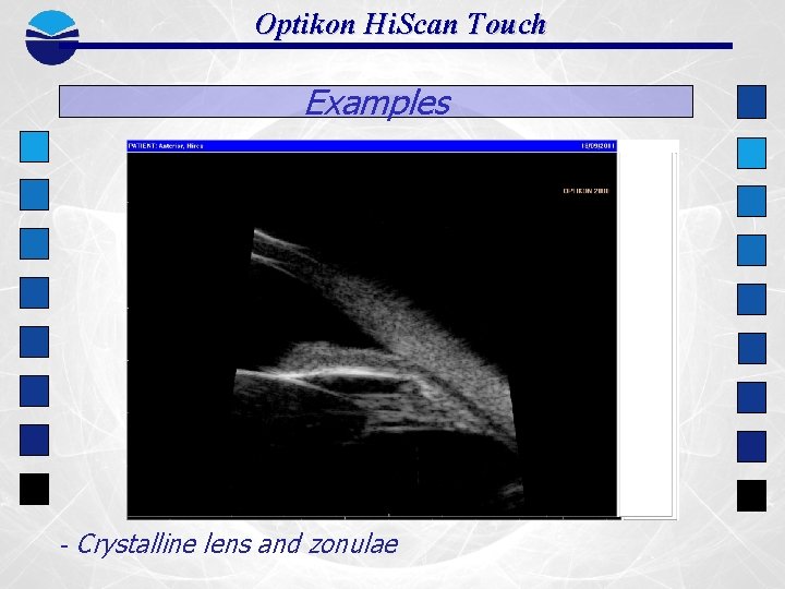 Optikon Hi. Scan Touch Examples - Crystalline lens and zonulae 