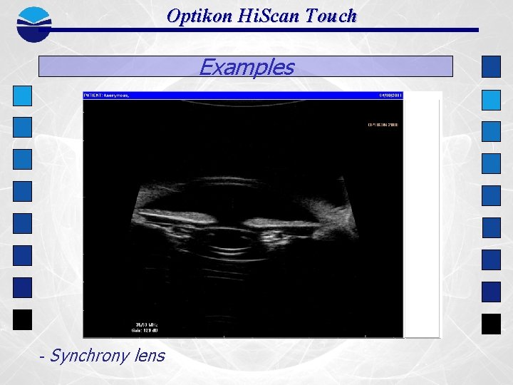 Optikon Hi. Scan Touch Examples - Synchrony lens 