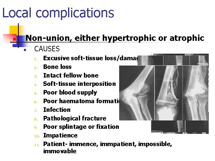 Local complications n Non-union, either hypertrophic or atrophic n CAUSES 1. 2. 3. 4.