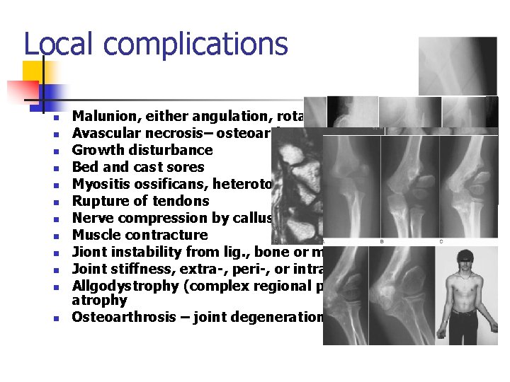 Local complications n n n Malunion, either angulation, rotation or shortening Avascular necrosis– osteoarthritis–