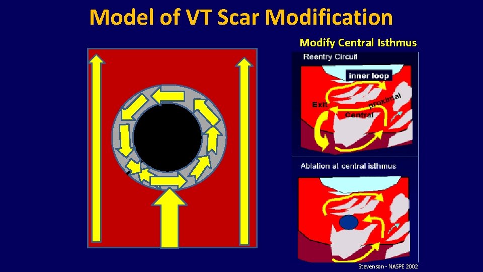 Model of VT Scar Modification Modify Central Isthmus Stevenson - NASPE 2002 Model of VT Scar Modification Modify Central Isthmus Stevenson - NASPE 2002