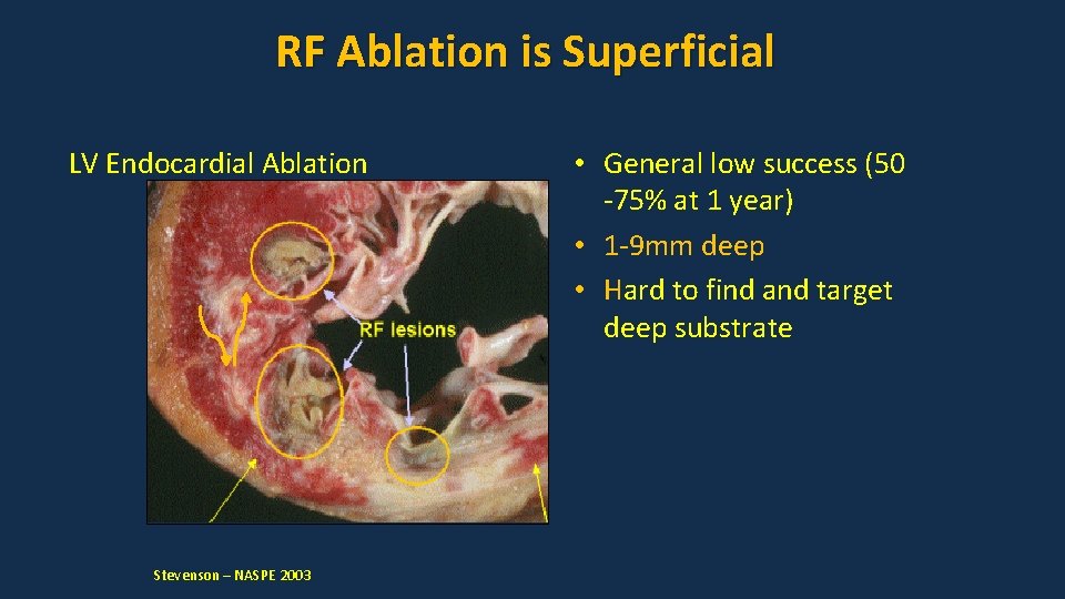 RF Ablation is Superficial LV Endocardial Ablation Stevenson – NASPE 2003 • General low RF Ablation is Superficial LV Endocardial Ablation Stevenson – NASPE 2003 • General low