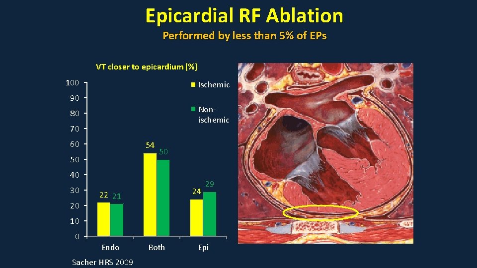 Epicardial RF Ablation Performed by less than 5% of EPs VT closer to epicardium Epicardial RF Ablation Performed by less than 5% of EPs VT closer to epicardium