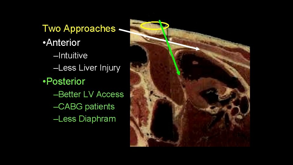 Two Approaches • Anterior –Intuitive –Less Liver Injury • Posterior –Better LV Access –CABG Two Approaches • Anterior –Intuitive –Less Liver Injury • Posterior –Better LV Access –CABG