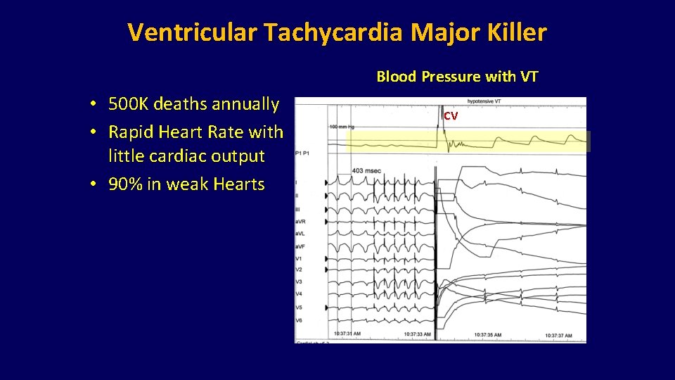 Ventricular Tachycardia Major Killer Blood Pressure with VT • 500 K deaths annually • Ventricular Tachycardia Major Killer Blood Pressure with VT • 500 K deaths annually •