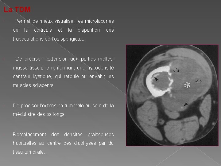 La TDM Permet de mieux visualiser les microlacunes de la corticale et la disparition