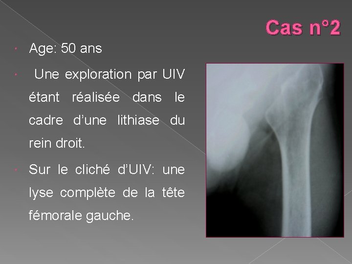 Cas n° 2 Age: 50 ans Une exploration par UIV étant réalisée dans le