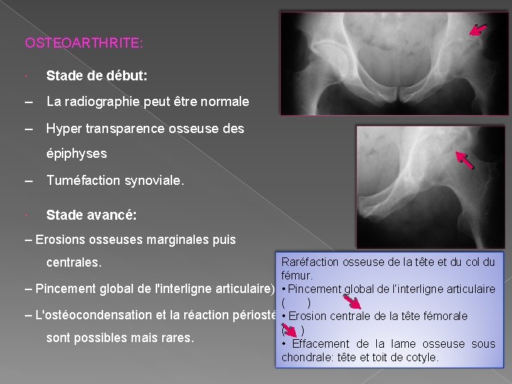 OSTEOARTHRITE: Stade de début: – La radiographie peut être normale – Hyper transparence osseuse