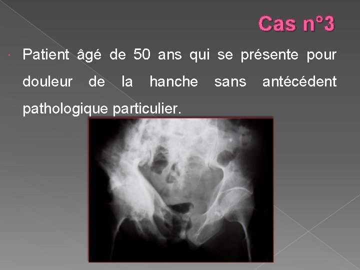 Cas n° 3 Patient âgé de 50 ans qui se présente pour douleur de