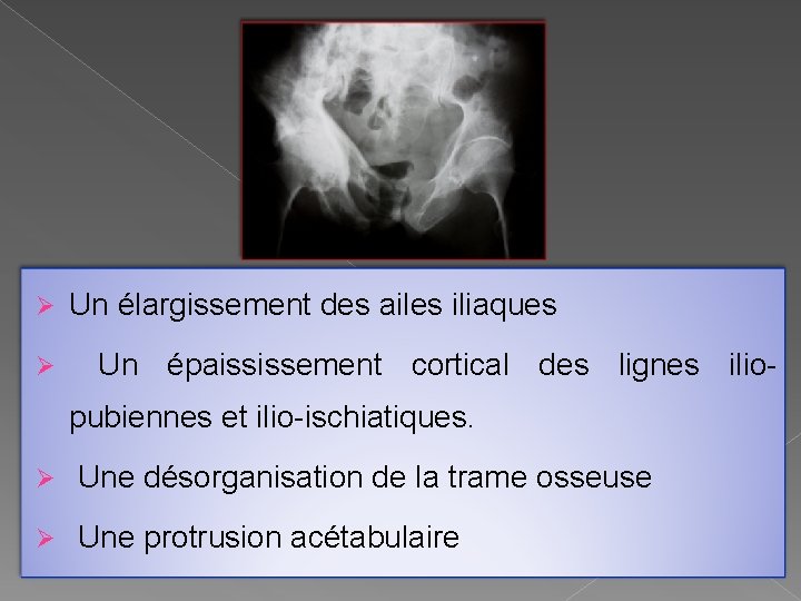Ø Un élargissement des ailes iliaques Ø Un épaississement cortical des lignes iliopubiennes et