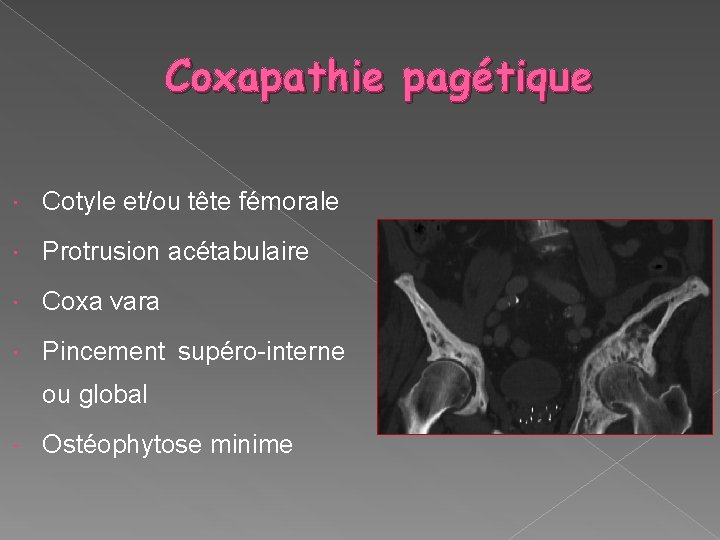 Coxapathie pagétique Cotyle et/ou tête fémorale Protrusion acétabulaire Coxa vara Pincement supéro-interne ou global
