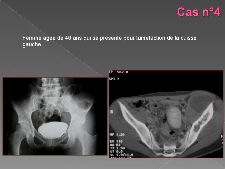 Cas n° 4 Femme âgée de 40 ans qui se présente pour tuméfaction de