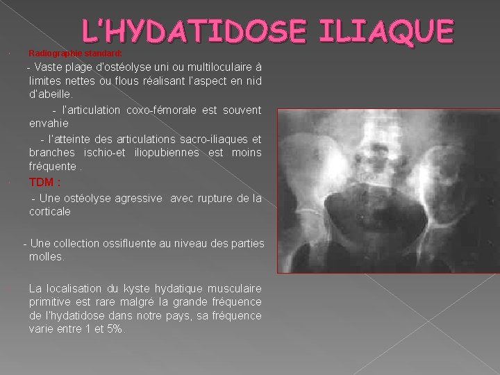  L’HYDATIDOSE ILIAQUE Radiographie standard: - Vaste plage d’ostéolyse uni ou multiloculaire à limites