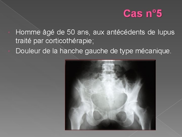 Cas n° 5 Homme âgé de 50 ans, aux antécédents de lupus traité par