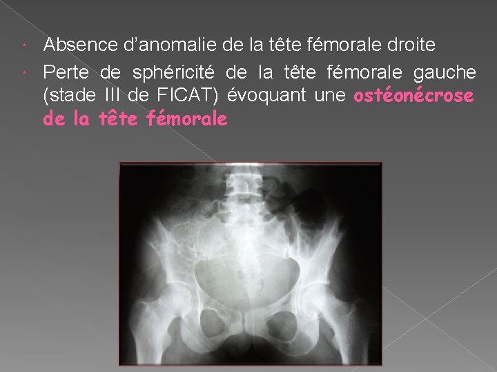 Absence d’anomalie de la tête fémorale droite Perte de sphéricité de la tête fémorale