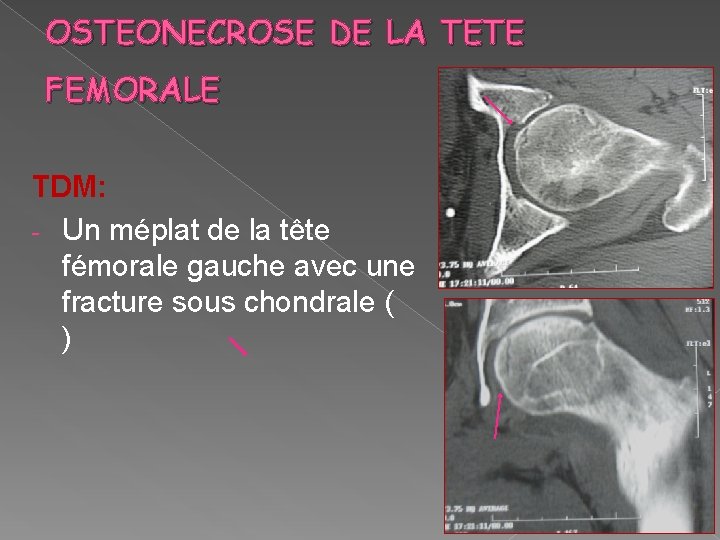 OSTEONECROSE DE LA TETE FEMORALE TDM: - Un méplat de la tête fémorale gauche