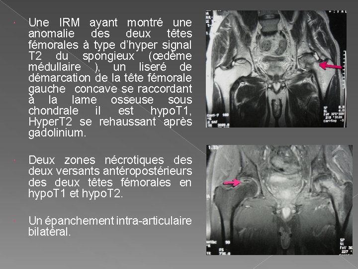  Une IRM ayant montré une anomalie des deux têtes fémorales à type d’hyper