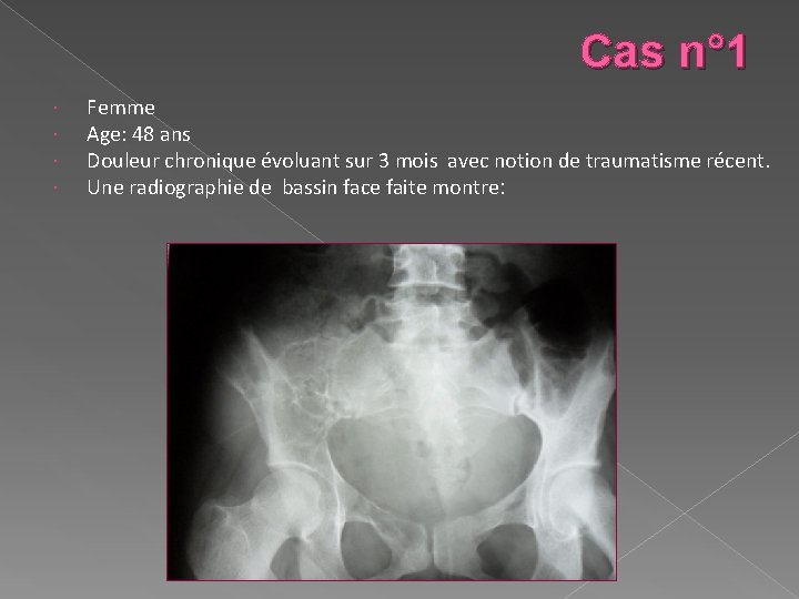 Cas n° 1 Femme Age: 48 ans Douleur chronique évoluant sur 3 mois avec