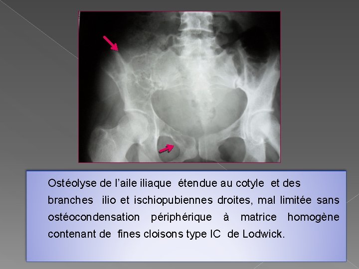 Ostéolyse de l’aile iliaque étendue au cotyle et des branches ilio et ischiopubiennes droites,