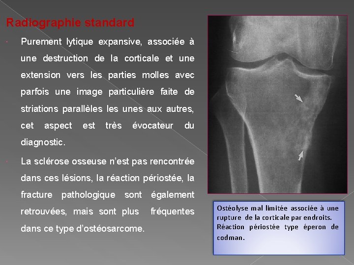 Radiographie standard Purement lytique expansive, associée à une destruction de la corticale et une