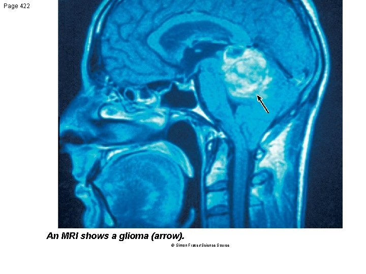 Page 422 An MRI shows a glioma (arrow). © Simon Fraser/Science Source 