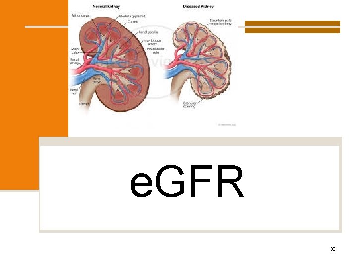 e. GFR 30 