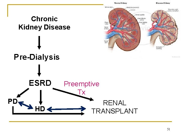 Chronic Kidney Disease Pre-Dialysis ESRD PD HD Preemptive Tx RENAL TRANSPLANT 51 