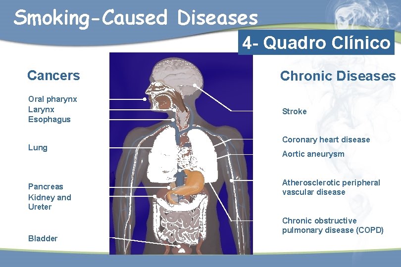 Smoking-Caused Diseases 4 - Quadro Clínico Cancers Chronic Diseases Oral pharynx Larynx Esophagus Stroke