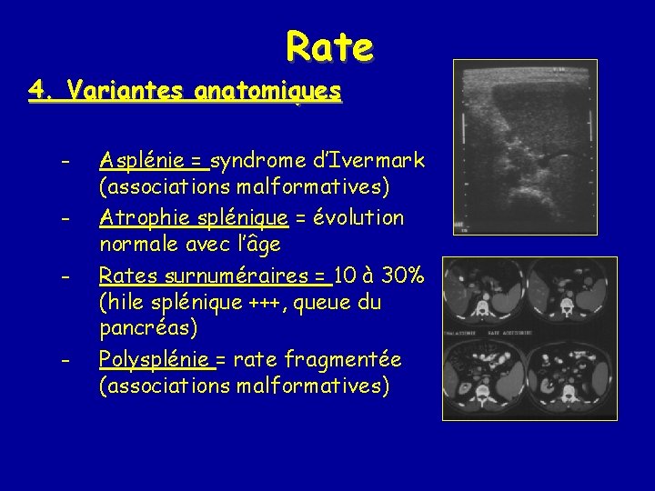 Rate 4. Variantes anatomiques - Asplénie = syndrome d’Ivermark (associations malformatives) Atrophie splénique =