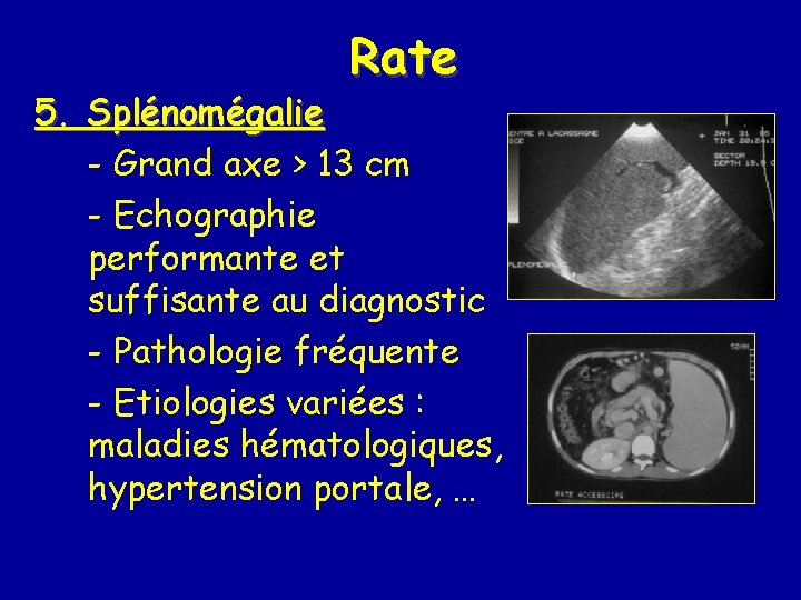 Rate 5. Splénomégalie - Grand axe > 13 cm - Echographie performante et suffisante
