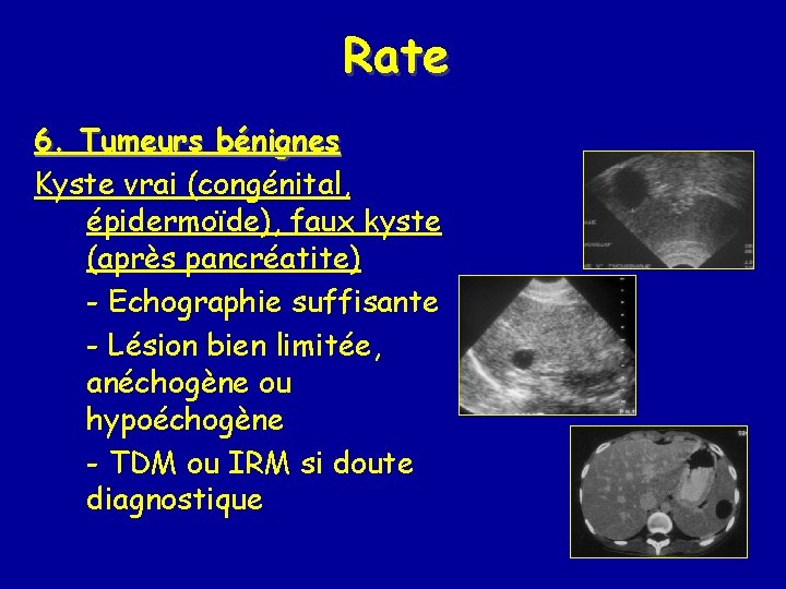 Rate 6. Tumeurs bénignes Kyste vrai (congénital, épidermoïde), faux kyste (après pancréatite) - Echographie