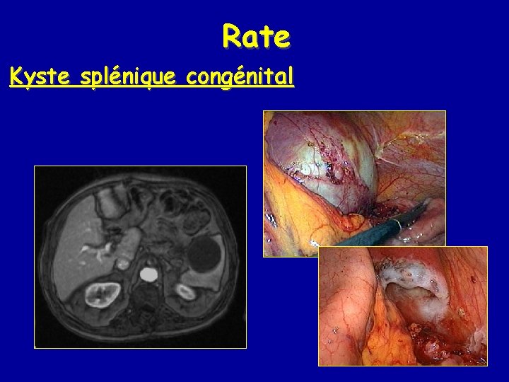 Rate Kyste splénique congénital 