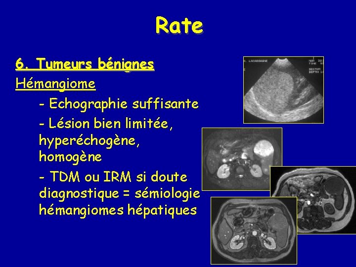 Rate 6. Tumeurs bénignes Hémangiome - Echographie suffisante - Lésion bien limitée, hyperéchogène, homogène