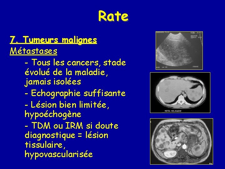 Rate 7. Tumeurs malignes Métastases - Tous les cancers, stade évolué de la maladie,