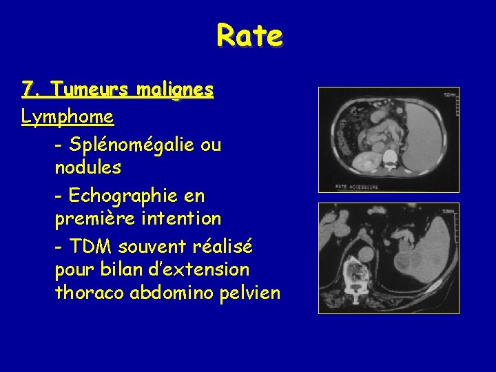 Rate 7. Tumeurs malignes Lymphome - Splénomégalie ou nodules - Echographie en première intention