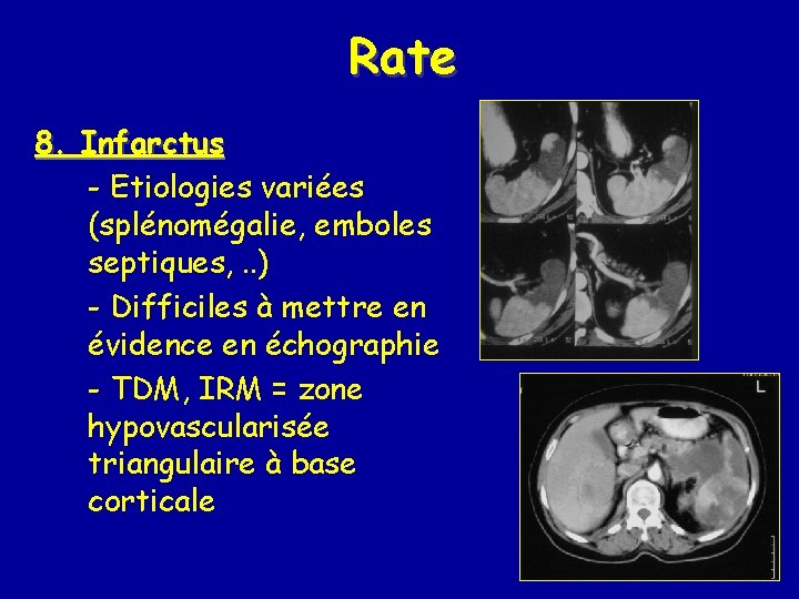 Rate 8. Infarctus - Etiologies variées (splénomégalie, emboles septiques, . . ) - Difficiles