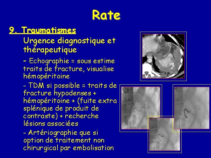 Rate 9. Traumatismes Urgence diagnostique et thérapeutique - Echographie = sous estime traits de