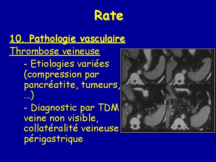 Rate 10. Pathologie vasculaire Thrombose veineuse - Etiologies variées (compression par pancréatite, tumeurs, …)