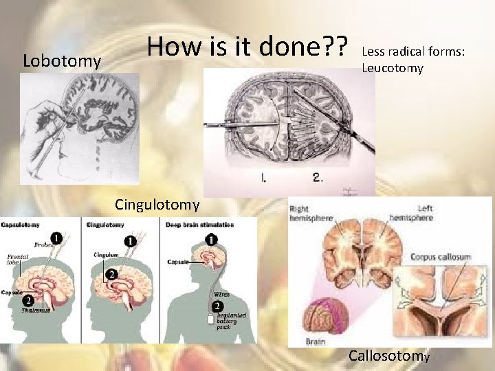 Lobotomy How is it done? ? Less radical forms: Leucotomy Cingulotomy Callosotomy 
