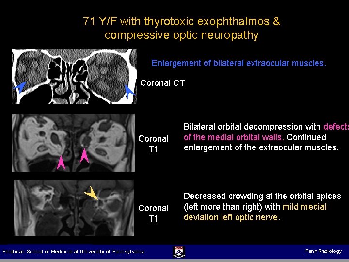 71 Y/F with thyrotoxic exophthalmos & compressive optic neuropathy Enlargement of bilateral extraocular muscles.