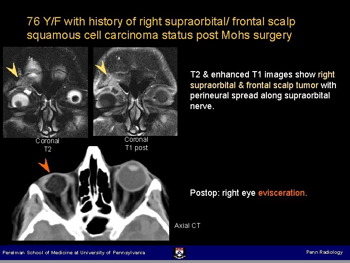 76 Y/F with history of right supraorbital/ frontal scalp squamous cell carcinoma status post