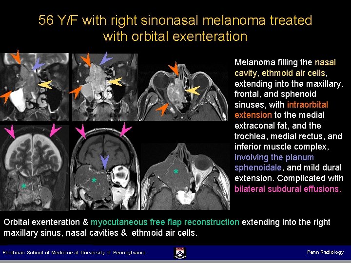 56 Y/F with right sinonasal melanoma treated with orbital exenteration * * * Melanoma